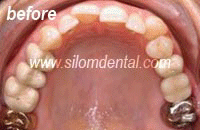 after iBraces lingual orthodontics, custom lingual brackets tretment
