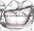 iBraces lingual orthodontics technologies
