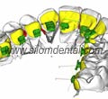 iBraces lingual braces technologies