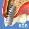 NobelActive implant - hight initial stability
