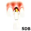 Premium solution with NobelReplace Tapered Groovy,
Procera Abutment and Procera Crown.