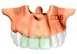 NobelGuide diagnostic tooth setup