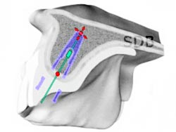 NobelGuide prosthetic diven treatment planning