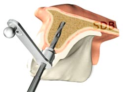 NobelGuide guide implant site preparation