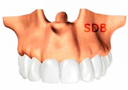 NobelGuide impression based final restoration