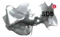 NobelGuide diagnostic tooth setup