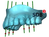 NobelGuide prosthetic diven treatment planning