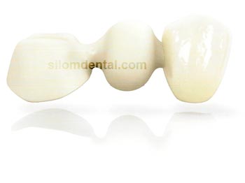 NobelProcera Bridge Zirconia