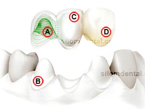 NobelProcera Bridge Zirconia