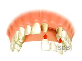 nobel procera bridge zirconia