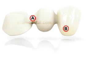 NobelProcera Bridge Zirconia