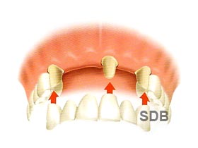 nobel procera bridge zirconia