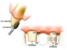 NobelProcera Bridge Zirconia