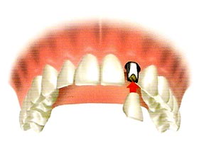 nobel procera implant abutment