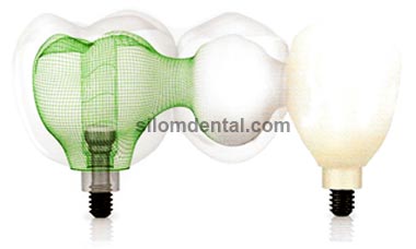 nobel procera implant bridge