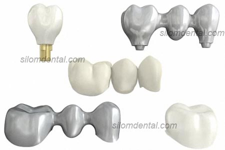 Nobel Procera Crown, Nobel Procera Bridge, Nobel Procera Laminate, Nobel Procera Bridge Zirconia, Nobel Procera Bridge Alumina, Nobel Procera Bridge Titanium