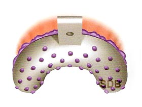 impression coping implant