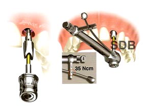 abutment connection