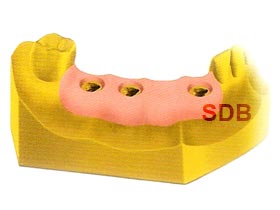 zirconia implant bridge