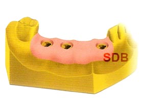 zirconia implant bridge