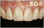 NobelRondo Alumina Procera Crowns (before)