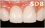 NobelRondo Alumina Crowns and Veneers (after)