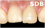 NobelRondo Alumina Crowns and Veneers (before)