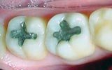 Before composite filling bangkok