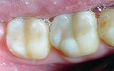After composite filling bangkok