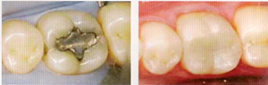 amalgam filling replaced