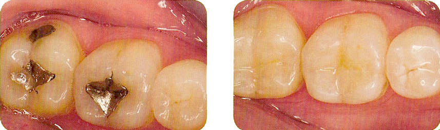 amalgam filling replaced