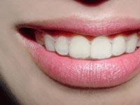 Clear Aligner or Invisalign