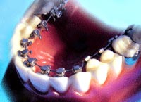 Lingual braces