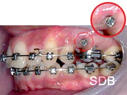 miniscrew for orthodontics treatment