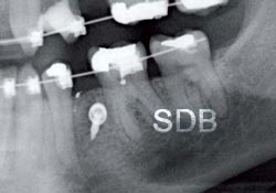 miniscrew for orthodontics treatment