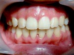 After Orthodontic treatment