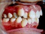 Before Orthodontic treatment