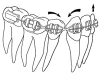 dental braces, Orthodontics