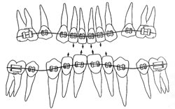 dental braces, Orthodontics