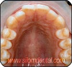 before STb Lingual treatment