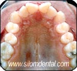 before STb Lingual treatment