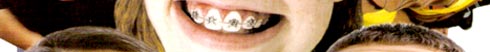Wild Smile Brackets in Orthodontics Clinic Thailand