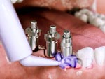 Cresco screw-retained implant bridges