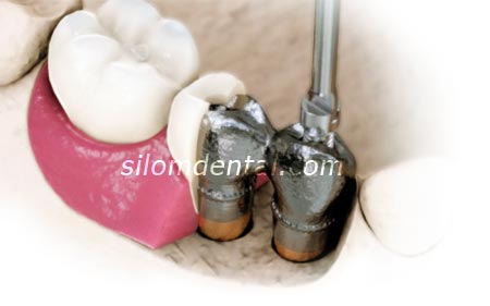 Cresco screw retained implant bridges Bangkok Thailand