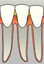 Missing Tooth and Receding Gum Tissue