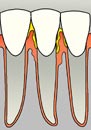 Missing Tooth and Receding Gum Tissue