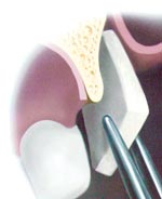 Soft Tissue Grafts