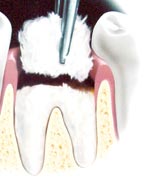 Bone Grafts