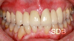  before dental bridges treatment