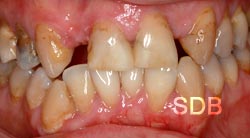  before dental bridges treatment